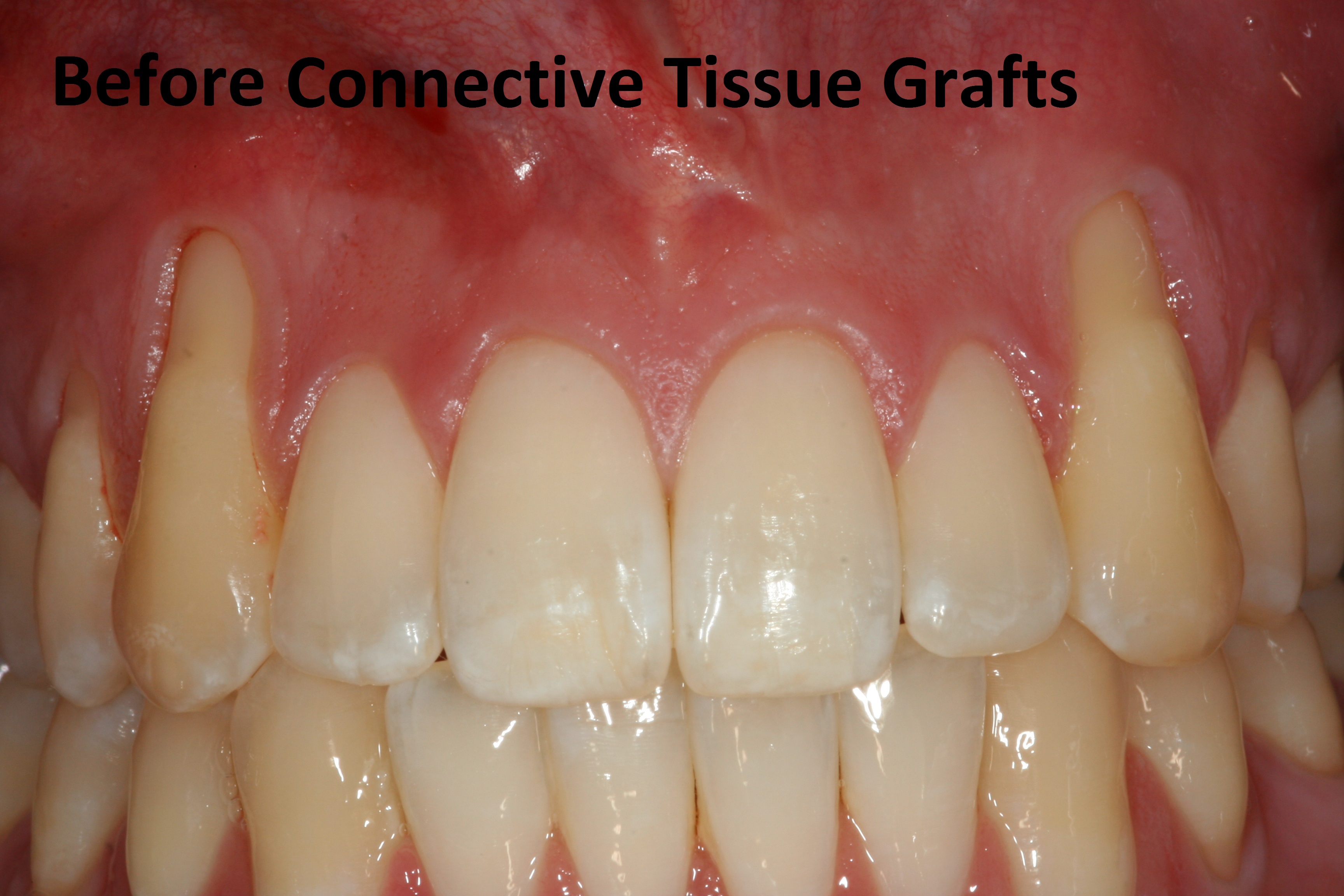 Before connective tissue grafting photo