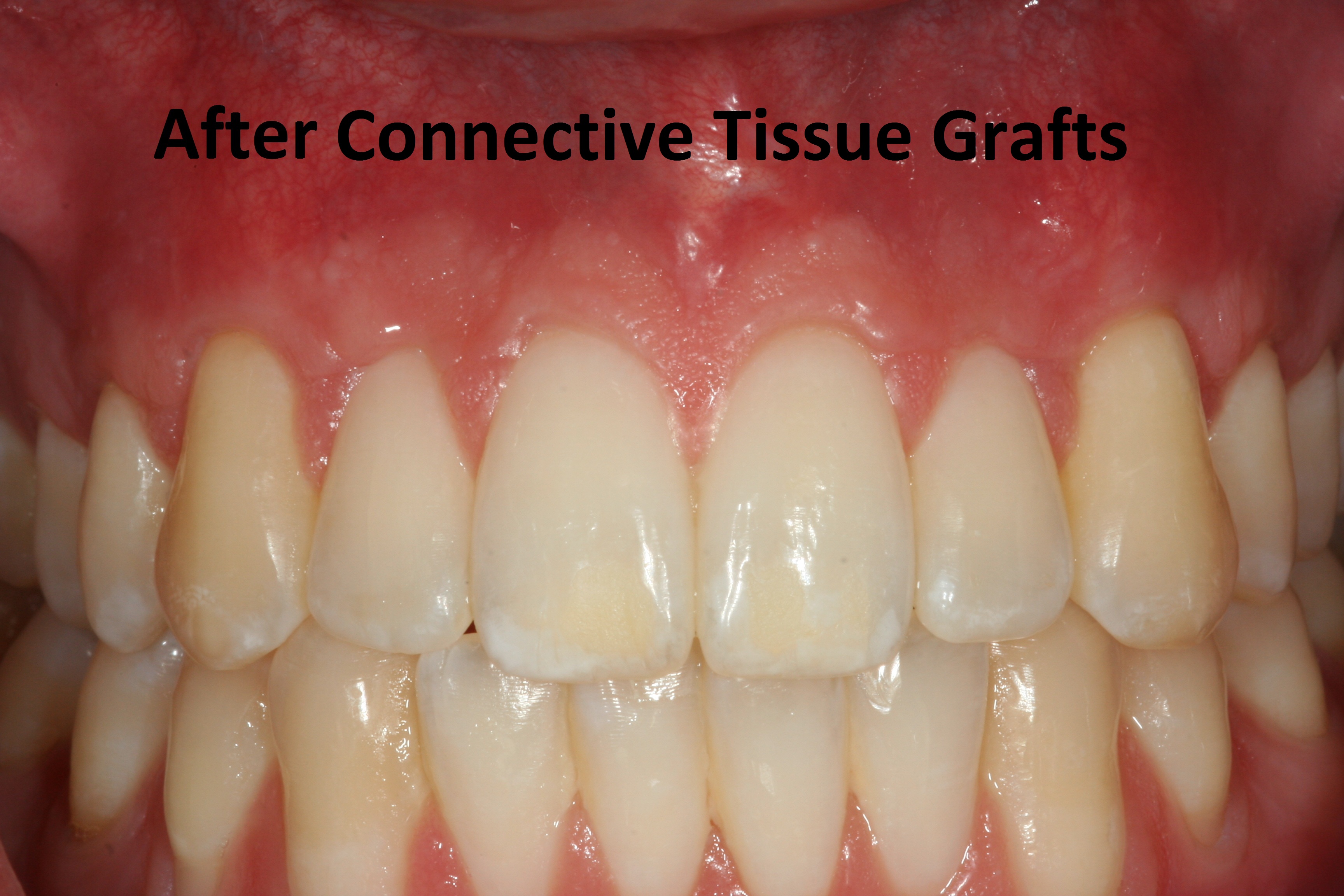 After connective tissue grafts photo