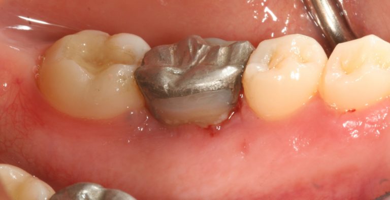 Close-up of three lower teeth, featuring a silver dental crown or filling on the middle tooth. The surrounding gum appears healthy, possibly after crown lengthening, and the adjacent teeth are natural.