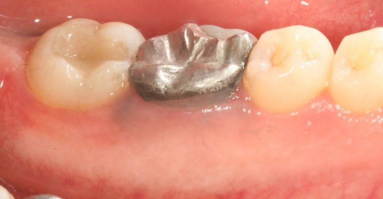 Close-up of three lower teeth, featuring a silver dental crown or filling on the middle tooth. The surrounding gum appears healthy, possibly after crown lengthening, and the adjacent teeth are natural.