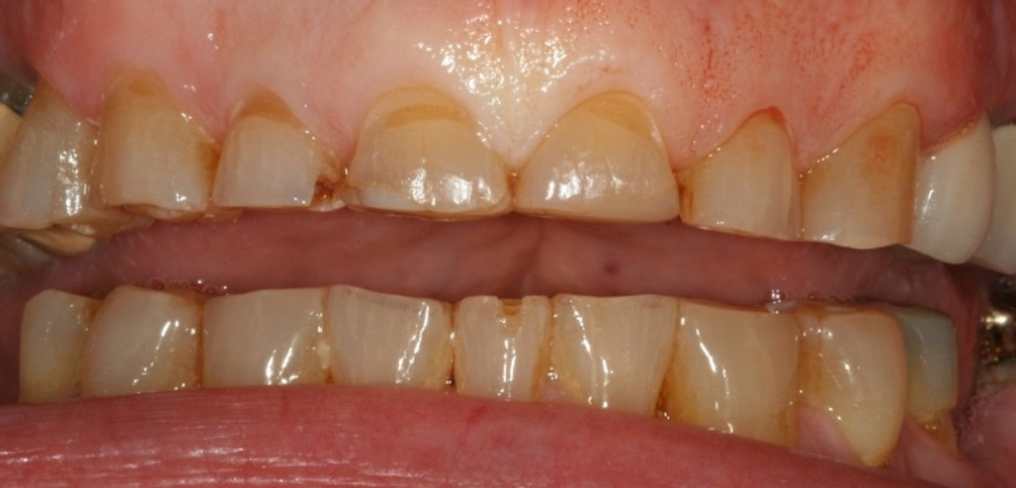 Close-up of upper and lower teeth with visible wear, discoloration, and erosion, showing yellowish stains and receding gums featured in our smile gallery.