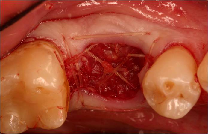Close-up of a dental surgical site after ridge augmentation, with visible sutures holding tissue together between two teeth, showing exposed gum and underlying structures following the procedure.