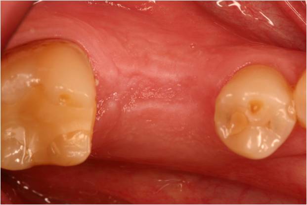 Close-up of upper gums with two molar teeth on either side and a missing tooth space in the middle, highlighting healthy pink gum tissue and an ideal site for ridge augmentation after tooth loss.