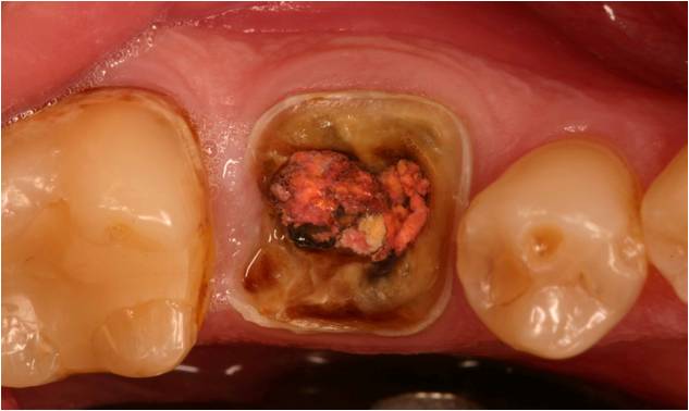 A close-up of a decayed tooth with its top surface removed, revealing exposed tooth pulp with reddish and brown discoloration, surrounded by neighboring teethâ€”an image that may highlight the need for ridge augmentation.