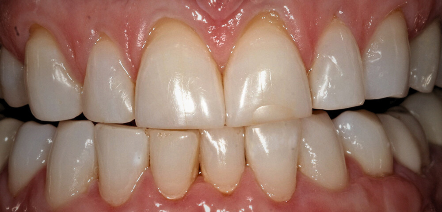 Untitled design – 2025-01-25T154935.816 Close-up of a persons teeth showing the upper and lower front teeth with the mouth slightly open; teeth appear clean and healthy, with normal gums visible—ideal for candidates considering the Chao Pinhole Technique.