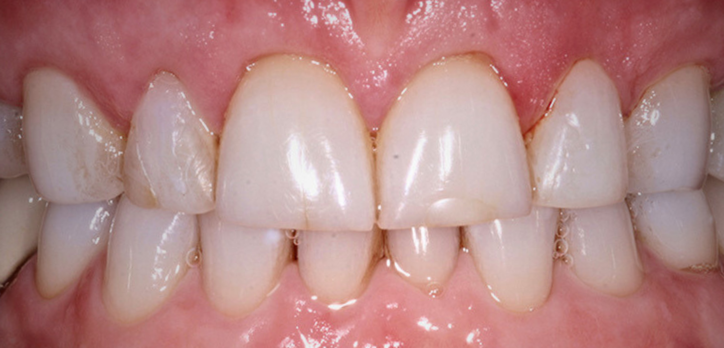 Close-up of a persons upper and lower front teeth showing mild gum inflammation, plaque buildup near the gumline, and slightly uneven tooth alignment. These signs may indicate a need for treatments like the Chao Pinhole Technique.