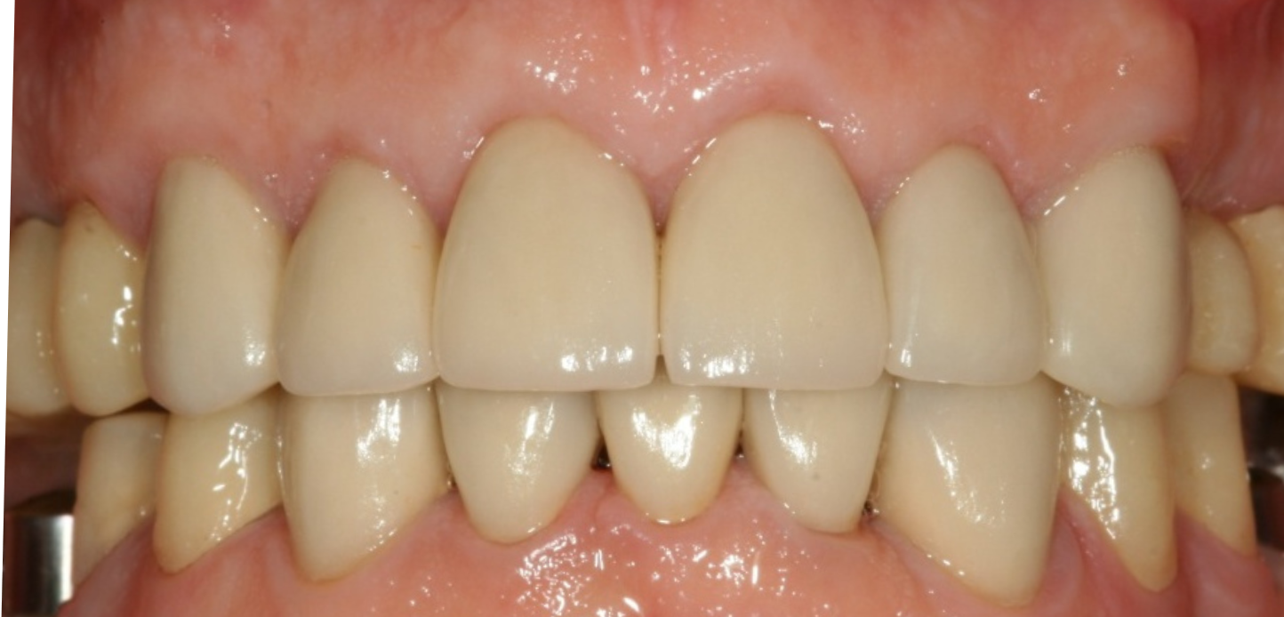 A close-up view of a person's mouth showing upper and lower teeth aligned together, with healthy-looking gums and clean, straight teethâ€”an ideal addition to any smile gallery.