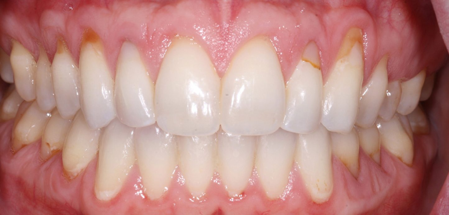 A close-up from our smile gallery shows a person's teeth with mild yellowish plaque buildup near the gum line. The gums appear slightly red and inflamed in some areas.