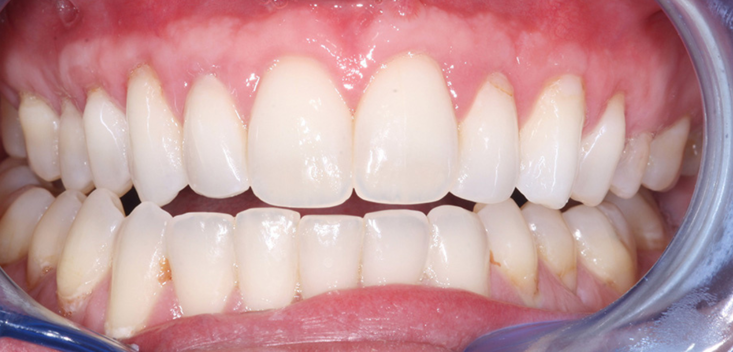 A close-up photo for a smile gallery showcases a personâ€™s mouth open wide, revealing clean, white teeth and healthy pink gums, with dental retractors gently holding the lips aside.