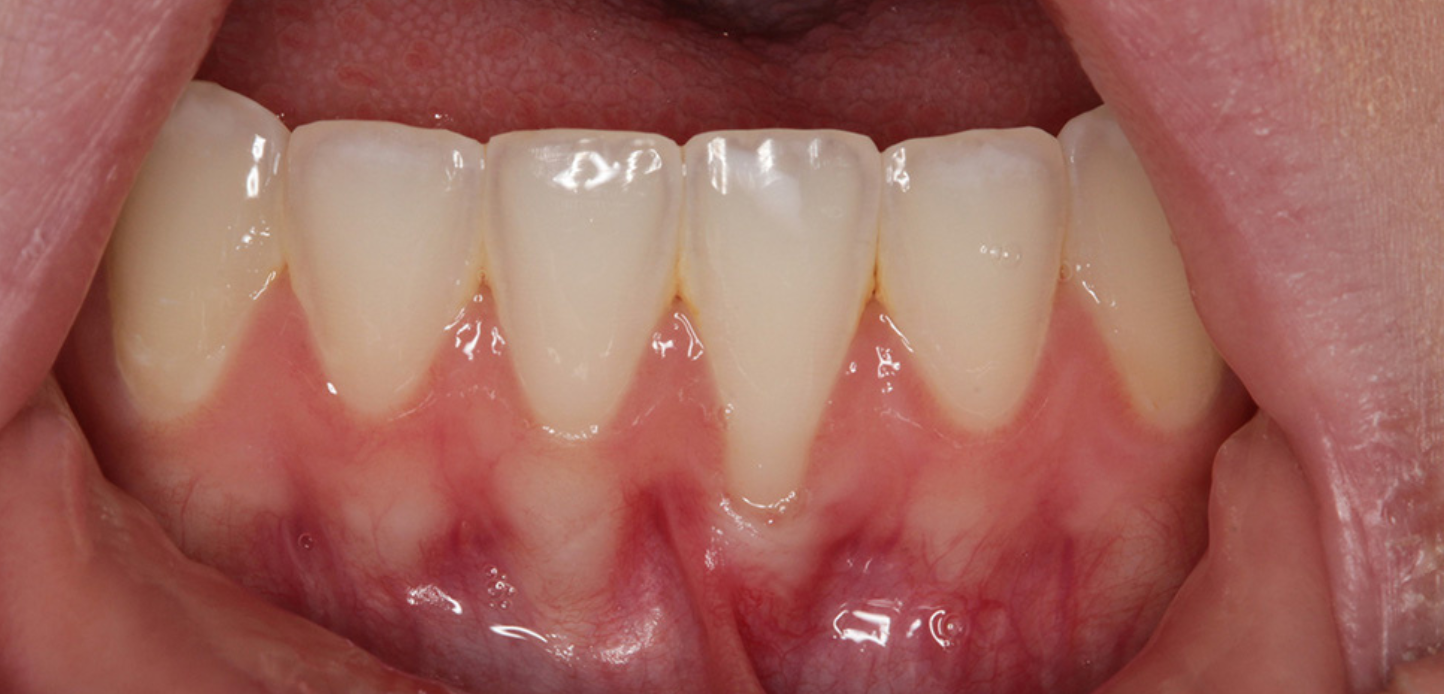 Close-up from our smile gallery reveals lower front teeth with noticeable gum recession, exposing the roots. The gums appear pink, with areas of redness visible along the gum line.