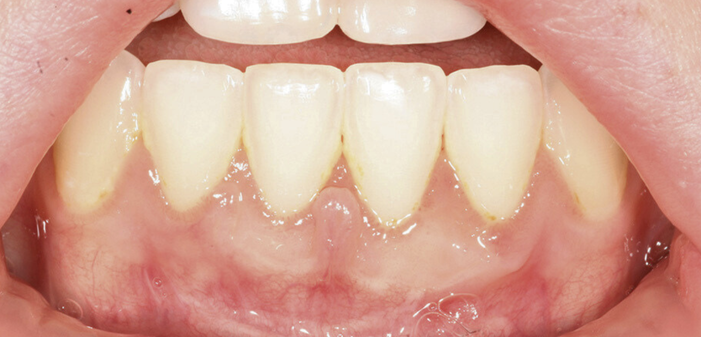 Close-up from our smile gallery shows a person's lower front teeth and gums with mild gum recession, slight yellowish tartar buildup near the gum line, and slightly inflamed gums.