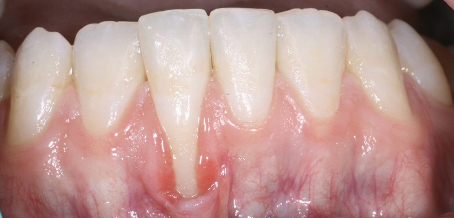 Close-up of lower front teeth and gums showing gum recession, with the gum tissue pulled away from one tooth, exposing more of the tooth surface and root. The exposed area appears red and inflamed in this smile gallery image.
