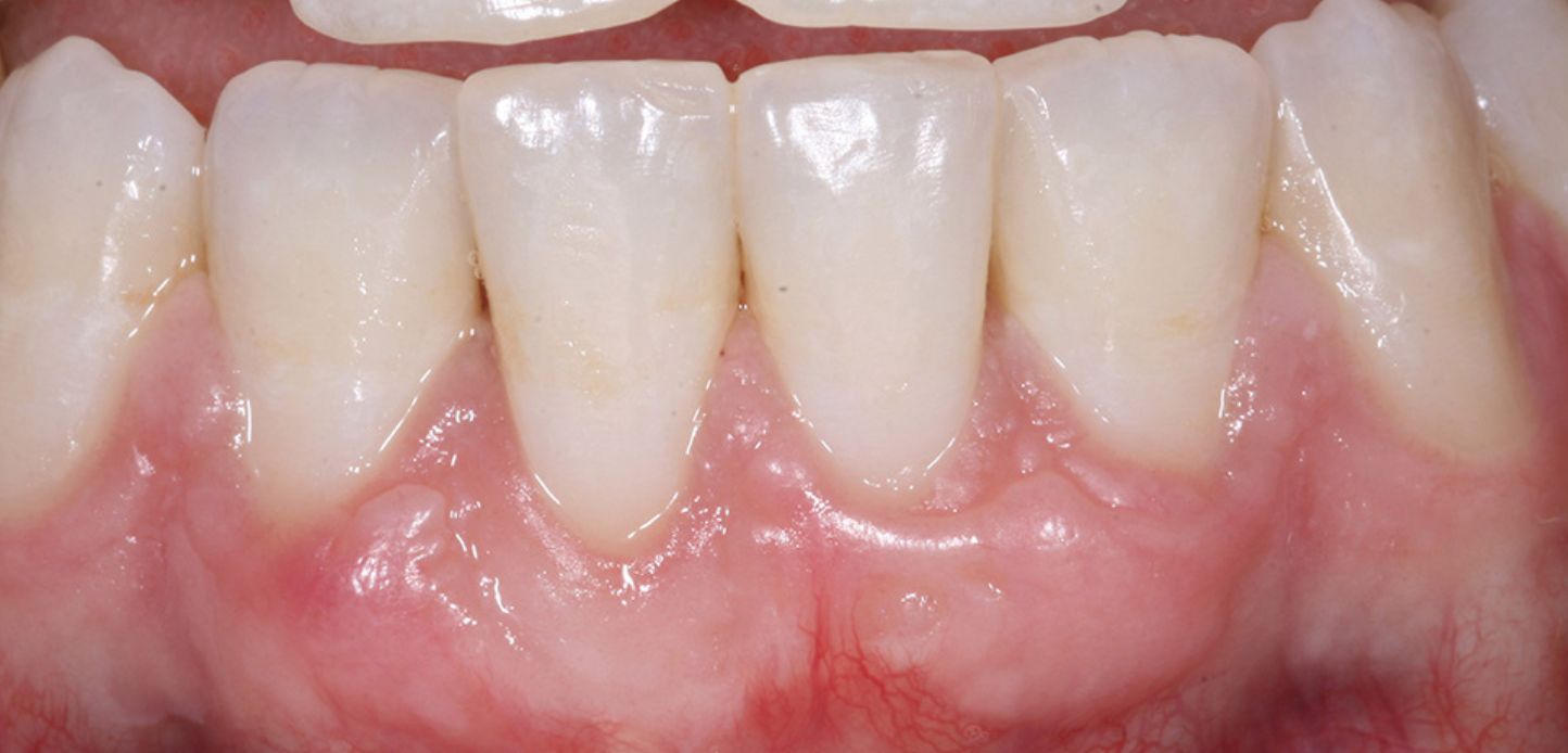 Close-up of lower front teeth and gums showing mild redness and swelling at the gumline, indicating possible early signs of gum disease or inflammation. Explore similar cases in our smile gallery.
