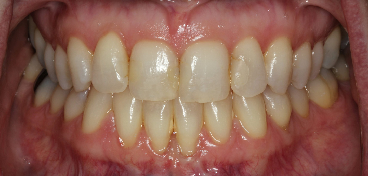 A close-up view of a person's mouth, as seen in a smile gallery, showing upper and lower teeth with healthy gums. The teeth appear natural, mostly straight, and clean, with slight variations in shade and minimal spacing.