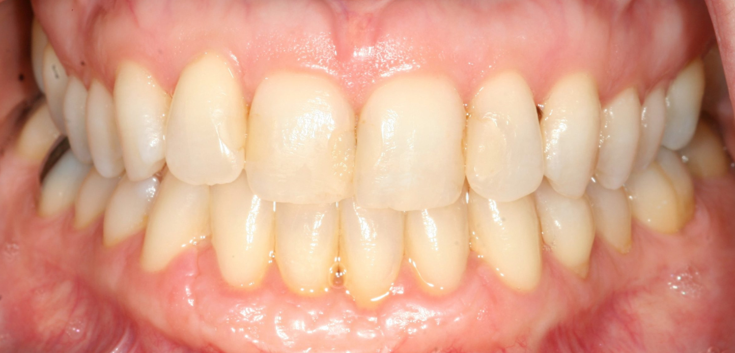 Close-up of a person's mouth showing both upper and lower teeth with visible gums, featured in our smile gallery. Teeth appear mostly healthy, with slight yellowing and some plaque buildup near the gum line.