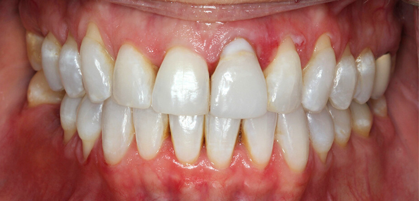 Close-up from a smile gallery shows a person's mouth with upper and lower teeth aligned but with visible plaque buildup near slightly red, inflamed gums. Lips are retracted to clearly display the teeth and gum line.