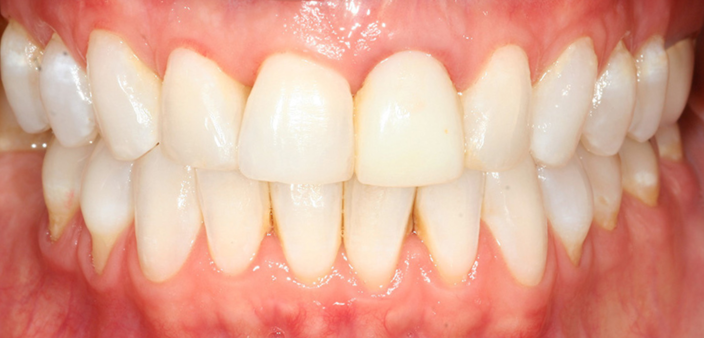 Close-up of a person's mouth showing healthy, clean, and well-aligned teeth with pink gums, perfect for a smile gallery.