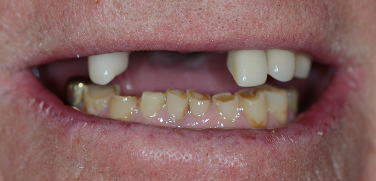 Close-up from our smile gallery: a person's mouth with missing upper front teeth, visible dental crowns, and lower teeth showing significant discoloration and decay. Lips are slightly parted, clearly revealing dental concerns.