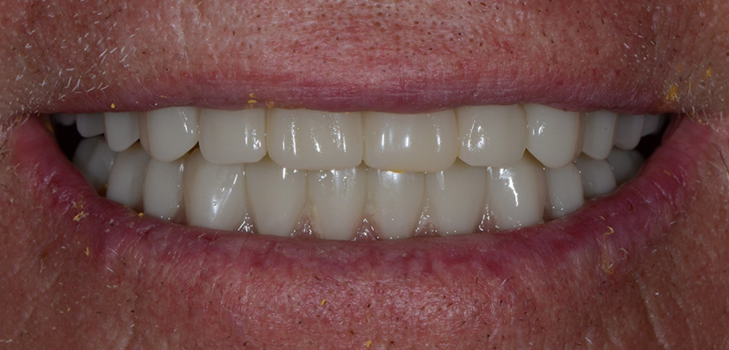 A close-up from our smile gallery reveals a person's mouth showing clean, straight, white teethâ€”likely dental implants or denturesâ€”with visible skin texture and some yellow residue around the lips.