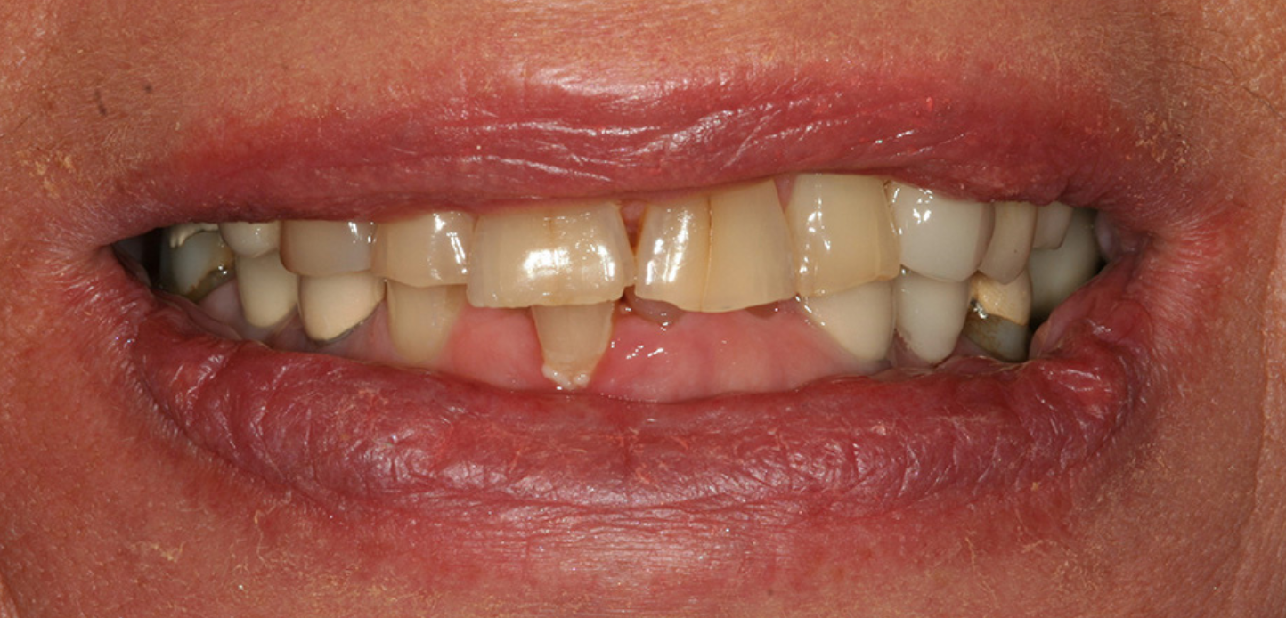 Close-up of a person's mouth showing upper teeth with discoloration, gaps, and broken or decayed teeth. The gums are visible, the lips appear dryâ€”an image for a smile gallery before-and-after showcase.