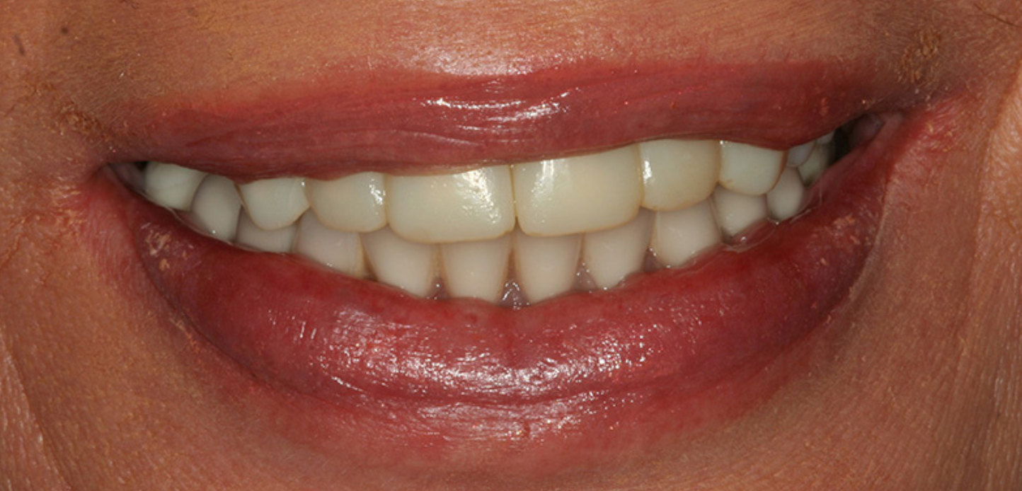 A close-up of a person's mouth showing a smile with clean, aligned, and healthy-looking teeth and glossy lipsâ€”perfect for any smile gallery.