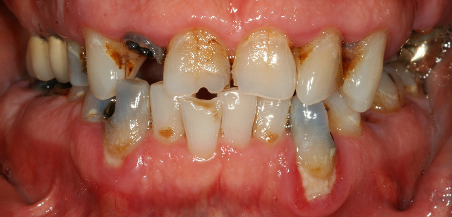 Close-up of a person's mouth featured in our smile gallery, showing severe tooth decay, cavities, discoloration, and gum disease. Several teeth are broken or missing, and the gums appear swollen and inflamed.