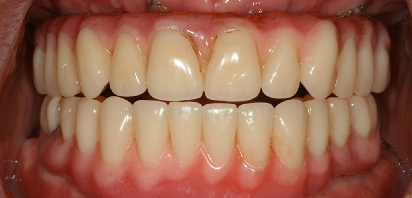 Close-up of a person's mouth showing upper and lower rows of clean, aligned teeth with healthy, pink gumsâ€”an ideal addition to any smile gallery. The teeth appear natural and well-maintained.