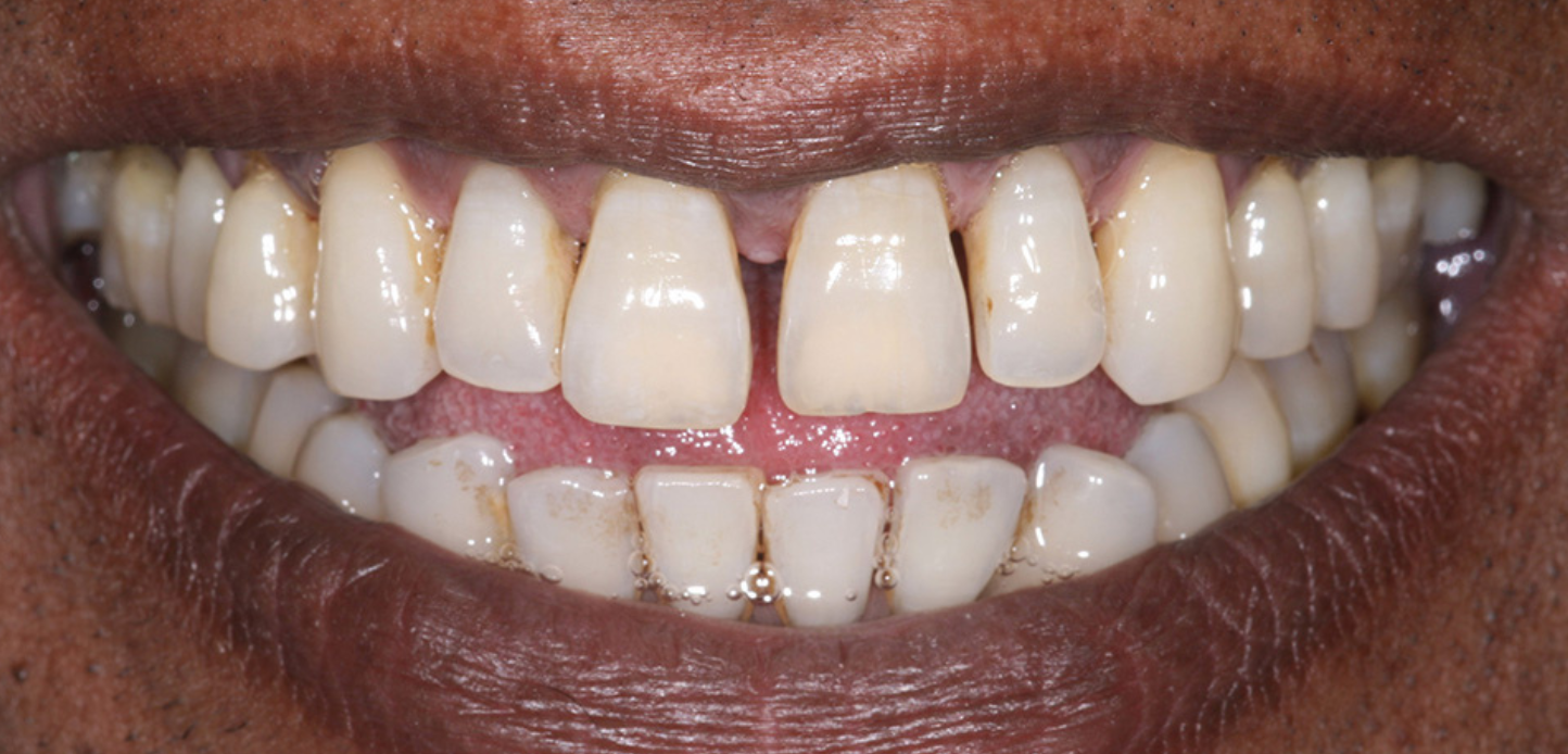 A close-up of a person's smile, showcasing their upper and lower teeth with slight spacing and visible yellowing and staining. The image could be part of a smile gallery, with lips and surrounding skin also clearly shown.