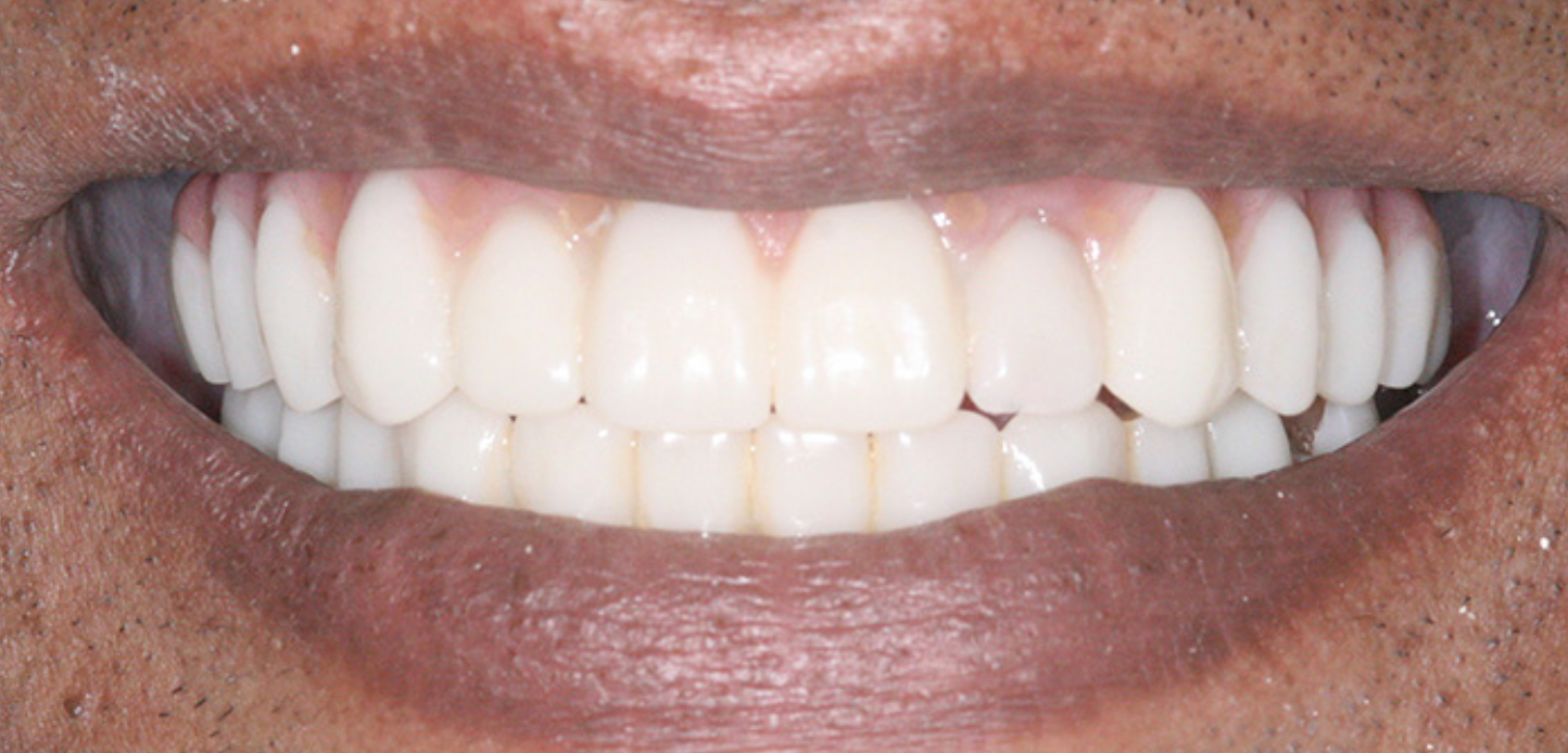 A close-up of a person's mouth smiling, showing straight, white teeth and healthy gums. The lips are parted to reveal both rows of teeth, making it a perfect addition to any smile gallery.