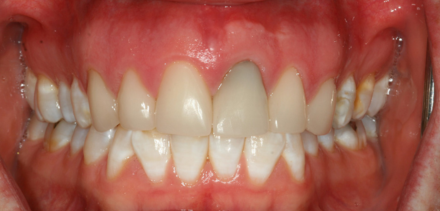 A close-up of a person's mouth showing teeth and gums, featured in a smile gallery. The upper front right tooth appears darker and slightly longer than the adjacent teeth, indicating possible dental restoration or discoloration.