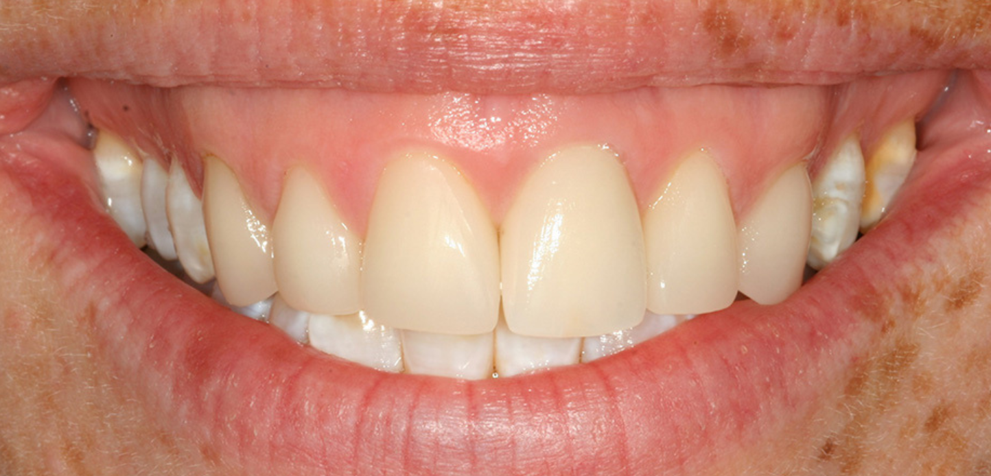 A close-up of a person's smile from our smile gallery, showing clean, healthy teeth and gums, with some freckles visible on the upper lip and surrounding skin.