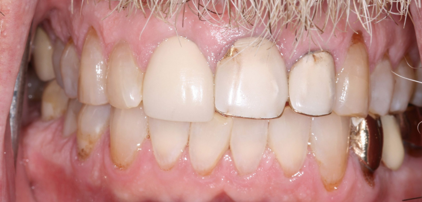 Close-up of a person's upper and lower teeth, featured in our smile gallery, showing dental crowns, metal restorations, and discoloration, with visible gums and facial hair at the top of the image.