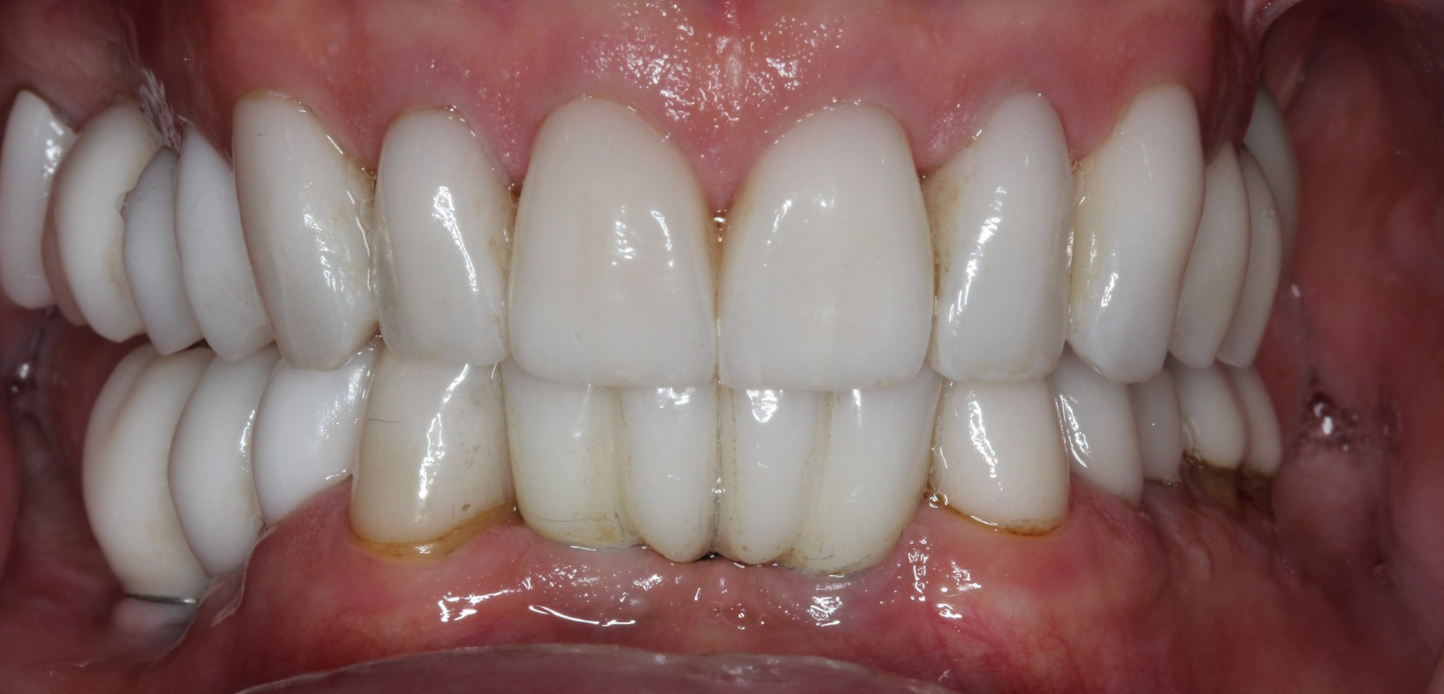 A close-up from our smile gallery shows a person's mouth with visible dental crowns or veneers, mild staining near the gumline, and healthy pink gums.