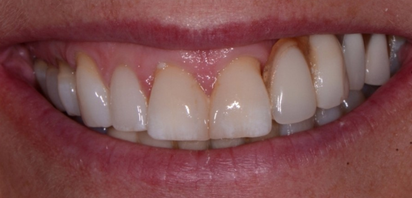 A close-up from our smile gallery shows a person's smile, highlighting upper and lower teeth with visible gum recession and brown discoloration near the gums of the upper front teeth.