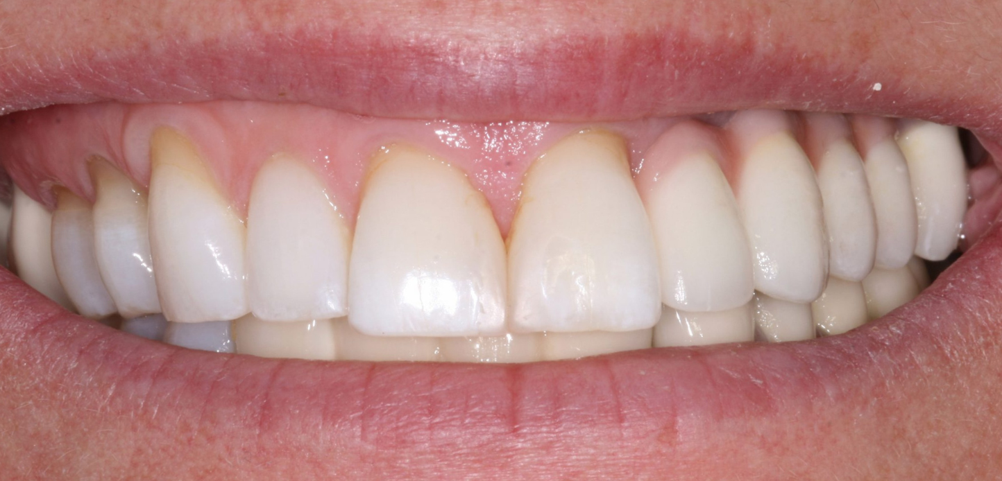 A close-up from our smile gallery shows a person's smile with upper and lower teeth, highlighting visible gum recession and discoloration near the gum line.