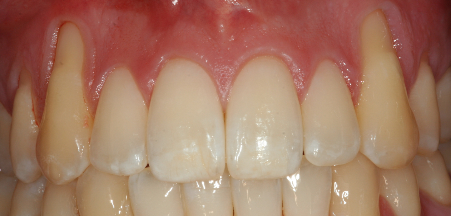 Untitled design – 2025-01-25T201514.179 Close-up of upper and lower front teeth and gums, showing healthy teeth with some visible gum recession on the upper left canine, which may benefit from gum grafting.