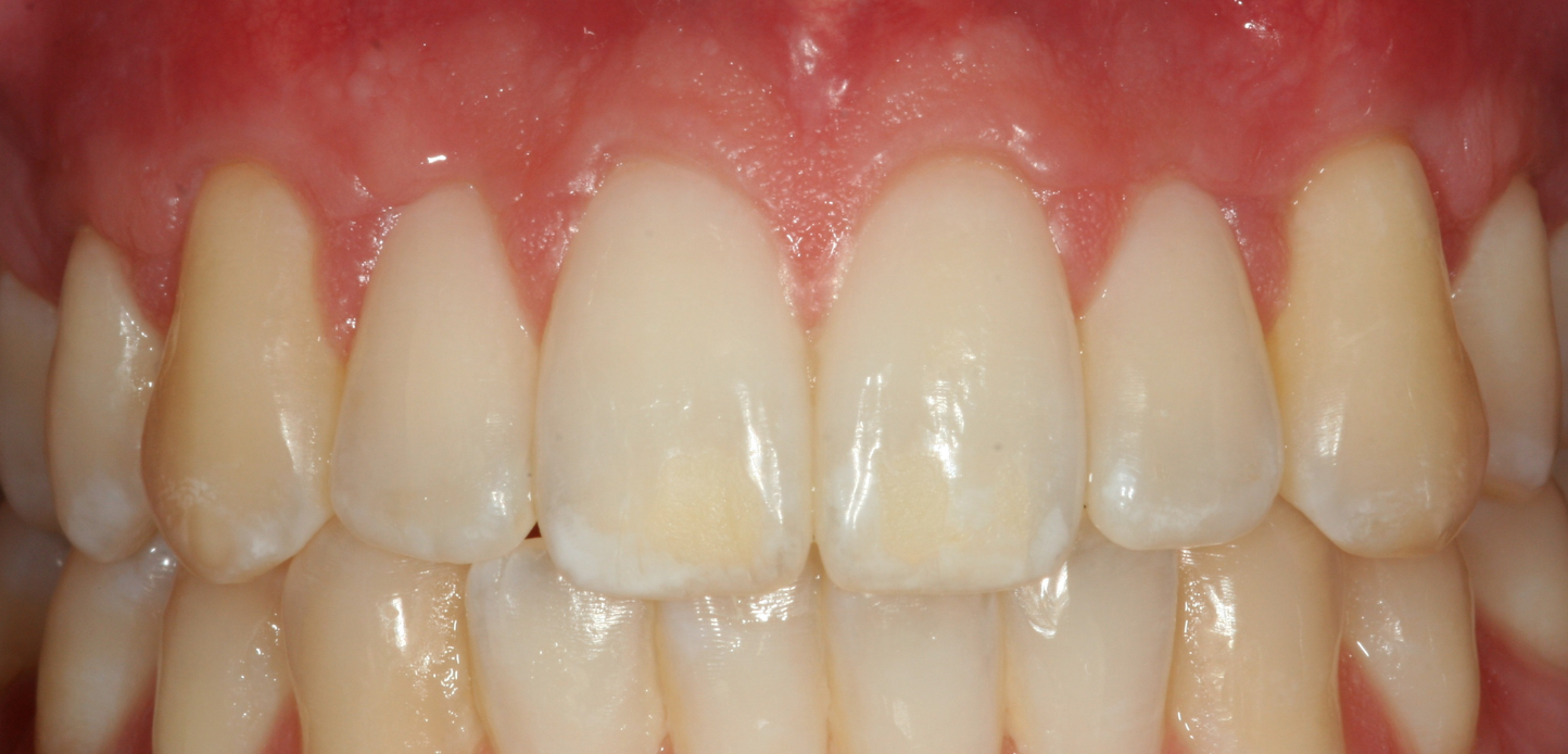 Close-up of upper and lower front teeth and gums, showing healthy teeth with some visible gum recession on the upper left canine, which may benefit from gum grafting.