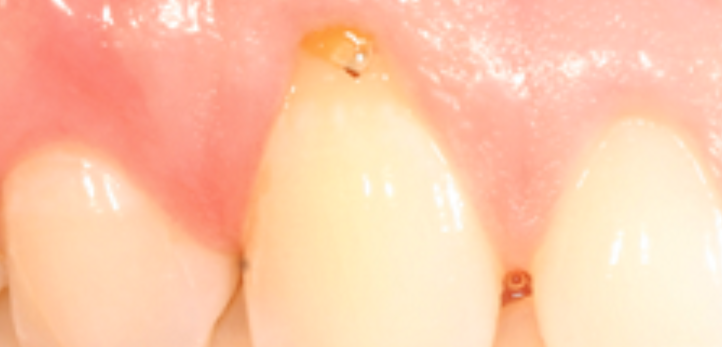 Untitled design – 2025-01-25T202212.114 A close-up of three upper front teeth, with the middle tooth showing visible decay and a cavity near the gumline. The healthy pink gums around the area suggest gum grafting is not currently needed.