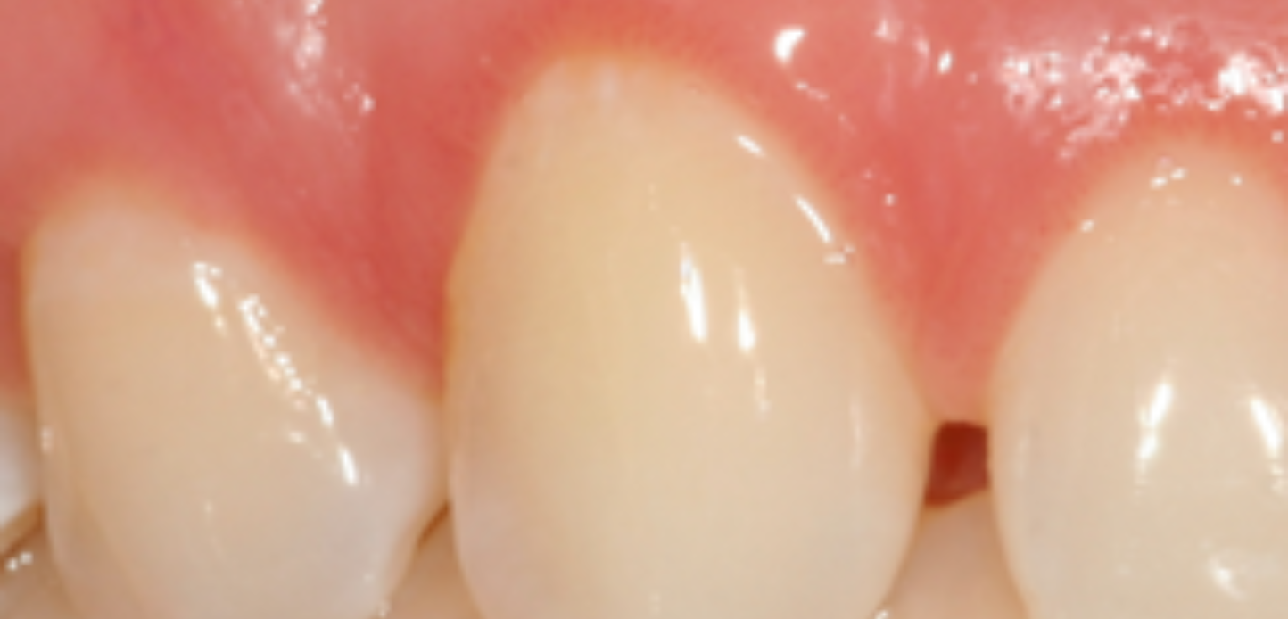 Close-up of three human teeth with healthy, pink gumsâ€”ideal for those considering gum grafting to maintain smooth enamel surfaces and prevent future gum issues.