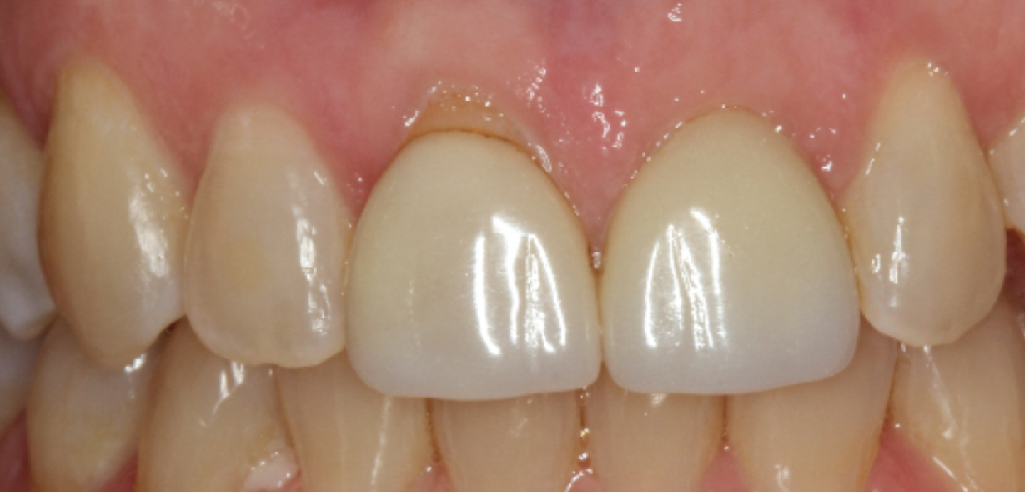 Untitled design – 2025-01-25T202348.246 Close-up of upper and lower front teeth showing gum recession and brownish discoloration near the gum line on some teeth, highlighting areas that may benefit from gum grafting.