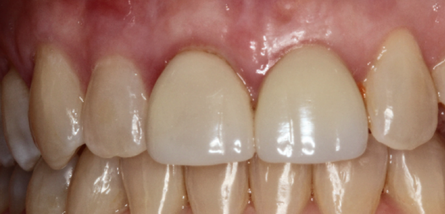 A close-up of upper and lower front teeth, showing healthy gumsâ€”possibly following gum graftingâ€”and dental crowns on the two upper central incisors, which appear slightly whiter and more opaque than the surrounding natural teeth.