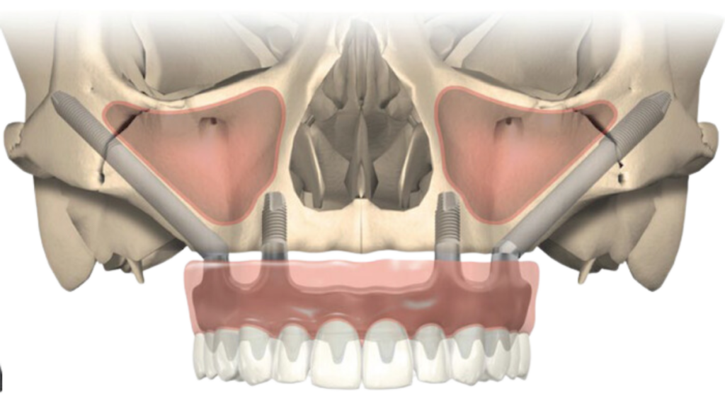 A diagram of a human skull showing zygomatic implants angled into the cheekbones, with a prosthetic upper dental arch in place.