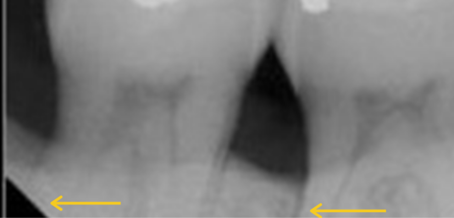 A dental X-ray showing the roots of two teeth with two yellow arrows at the bottom pointing to dark areas near the roots, possibly indicating bone loss or lesions that may require bone grafting.