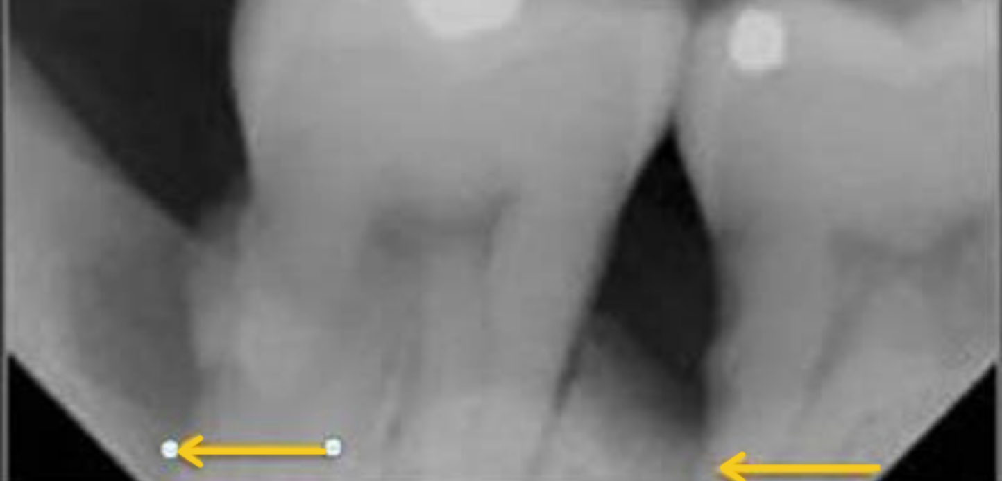 Untitled design – 2025-01-26T114104.070 Dental X-ray image showing two teeth, with two yellow arrows highlighting a dark area between the roots—an indicator that may require bone grafting at the bottom of the image.