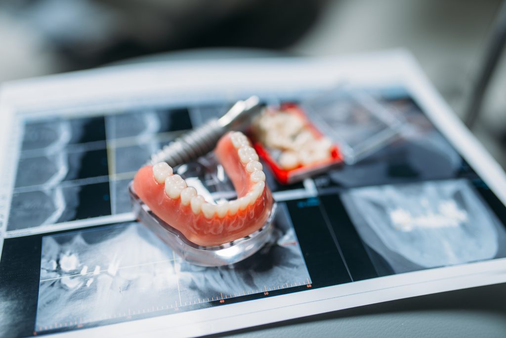 A dental implant model and artificial teeth set are placed on top of dental X-ray images, illustrating implant supported dentures and other oral health procedures.